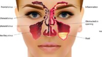 What is Sinus? (Know all about Sinus in Hindi)
