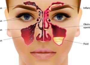 What is Sinus? (Know all about Sinus in Hindi)